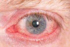 Gereiztes Auge bei Bindehautentzündung.